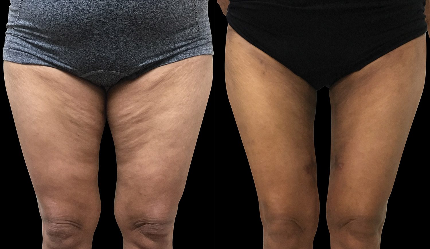 BA-slider-images-LACERNA-THIGH-53YO-v2